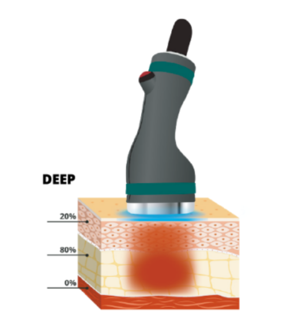 真皮層・脂肪層までピンポイントで届く